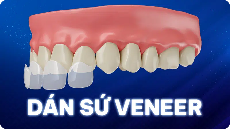 Giá Dán Sứ Veneer Nha Trang chỉ từ 1triệu/răng [BH 01-15 Năm]