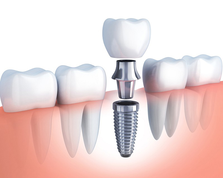 Trồng Răng Implant tại Nha Trang từ 17 Triệu/Răng xuất xứ Hàn Quốc