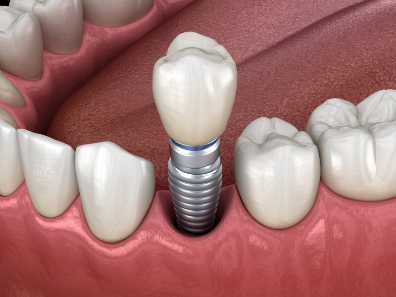 Trồng Răng Implant tại Nha Trang từ 17 Triệu/Răng xuất xứ Hàn Quốc