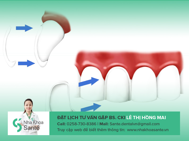 6 Lý do nên Dán răng sứ Veneer, Đánh giá chân thật từ khách hàng