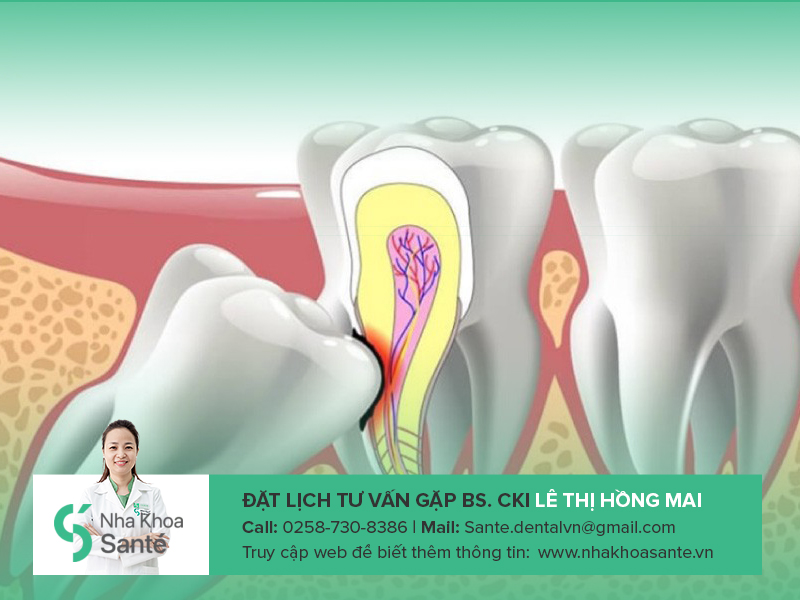 Hàm trên và hàm dưới Mọc răng khôn phải làm sao?