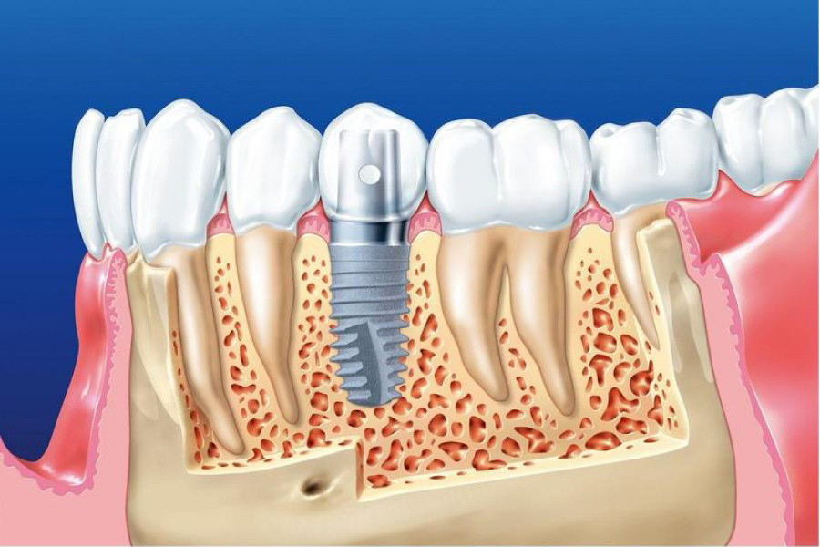 Trồng Răng Implant Và Những Điều Bạn Cần Biết