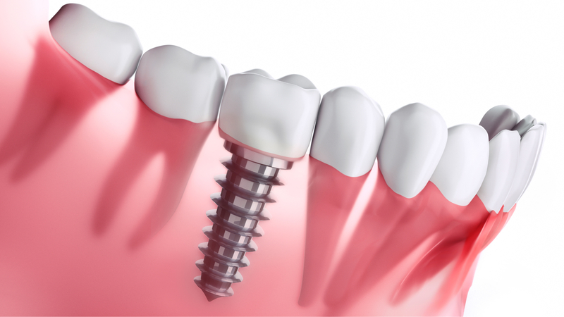 5 Sự khác nhau giữa các loại Implant có thể bạn chưa biết