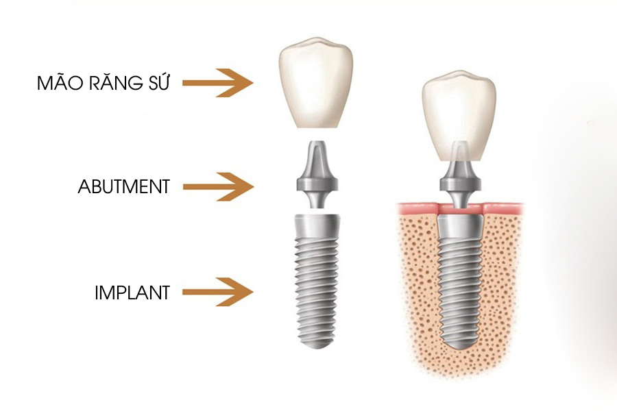 Có nên Trồng Răng Implant giá rẻ? Những rủi ro có thể xảy ra