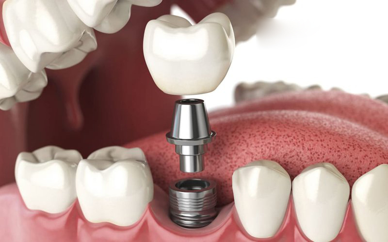 Có nên Trồng Răng Implant giá rẻ? Những rủi ro có thể xảy ra