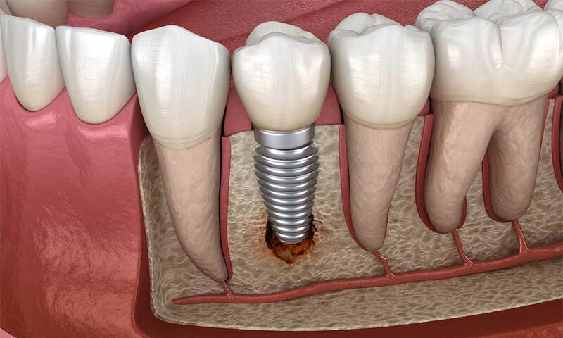 7 Rủi Ro Cần Biết Khi Quyết Định Trồng Răng Implant