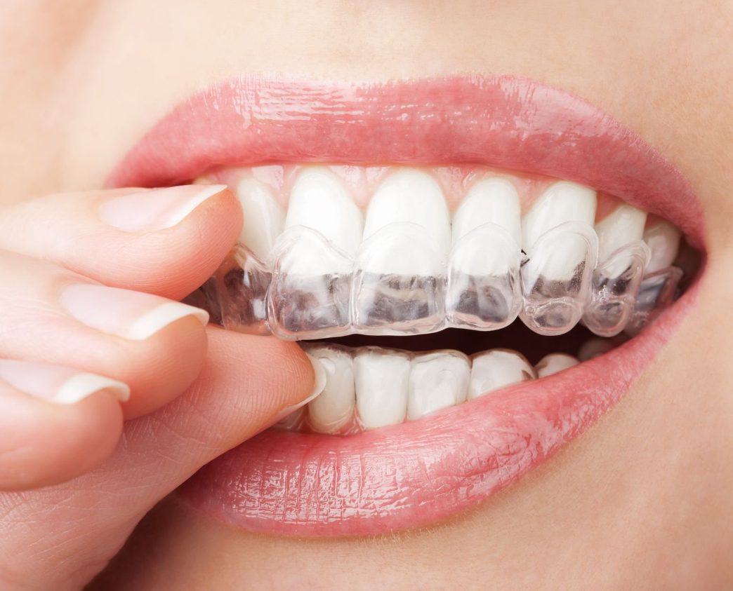 Tất Tần Tật Về Niềng Răng Trong Suốt Invisalign 2025